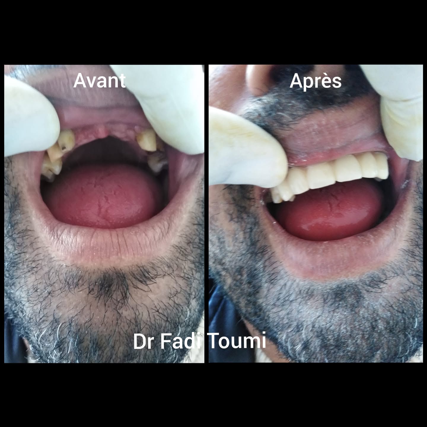 Sourire aligné adulte