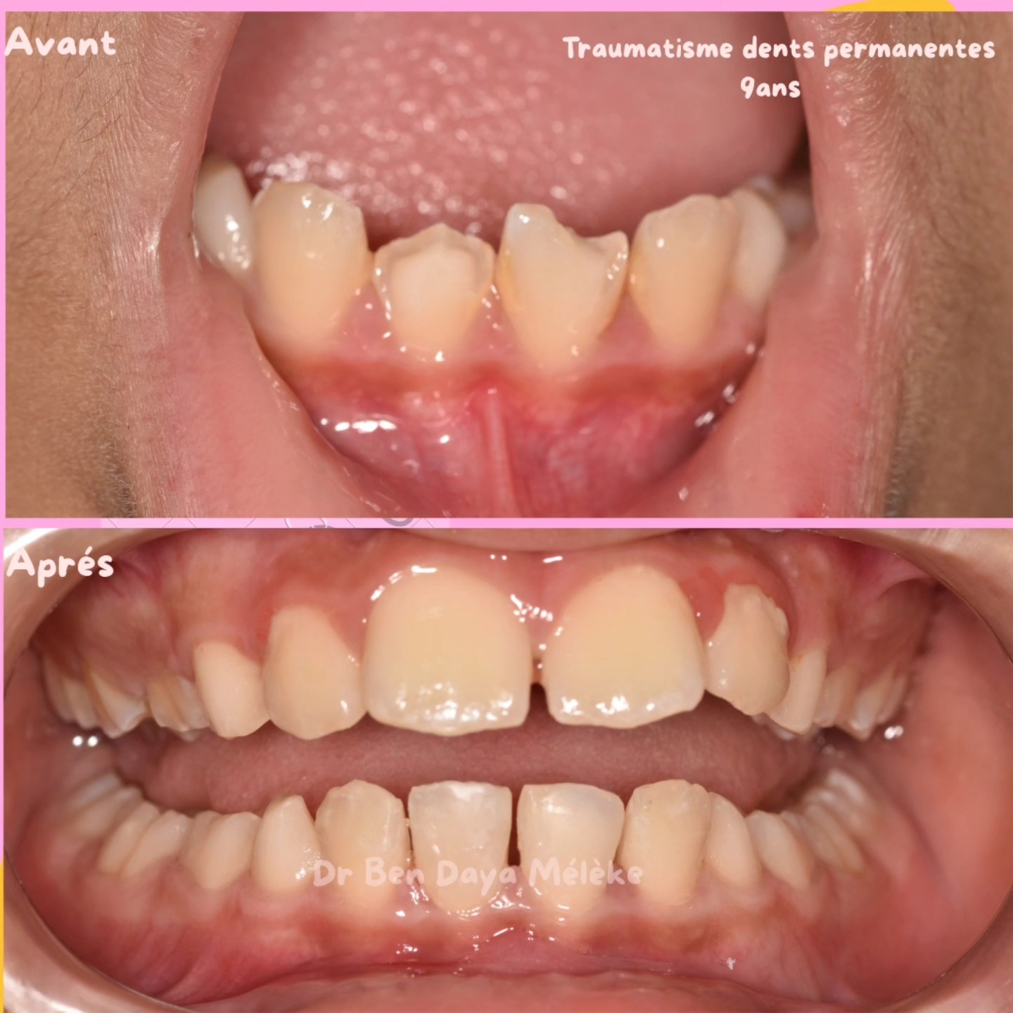 Orthodontie enfant et pédiatrique