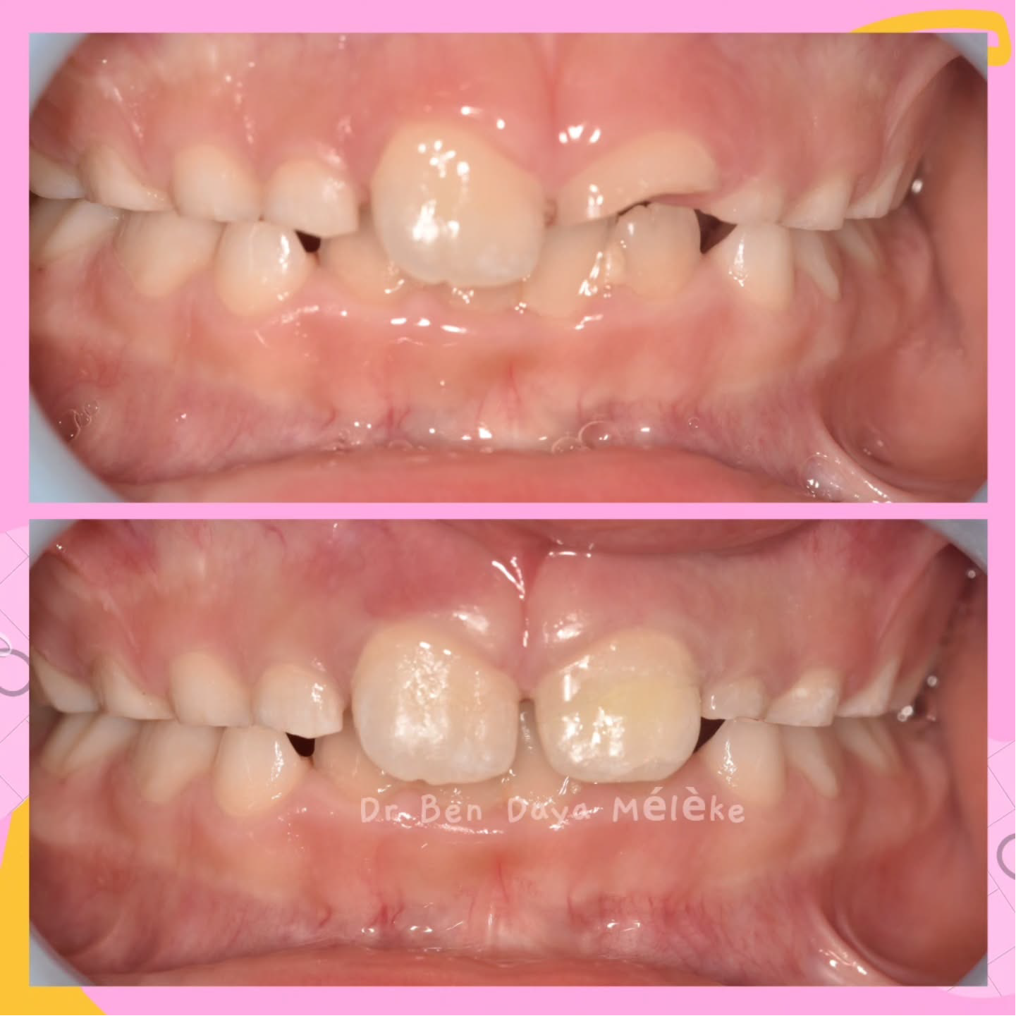 Préparation de gouttière orthodontique